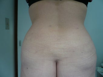 Smartlipo / liposuction