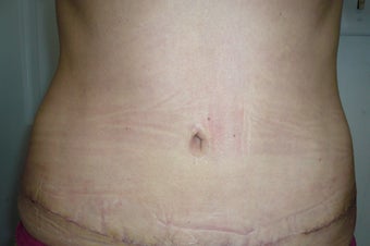 Smartlipo / liposuction