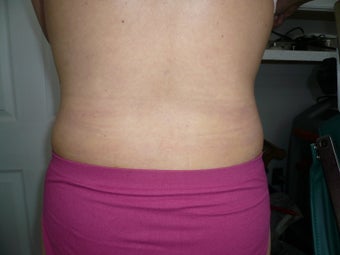Smartlipo / liposuction