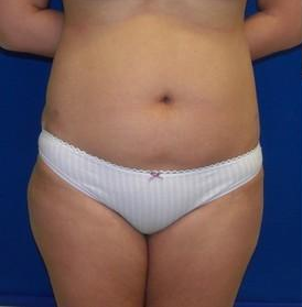 Laser Liposuction
