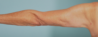 SmartLipo Liposuction of Arms