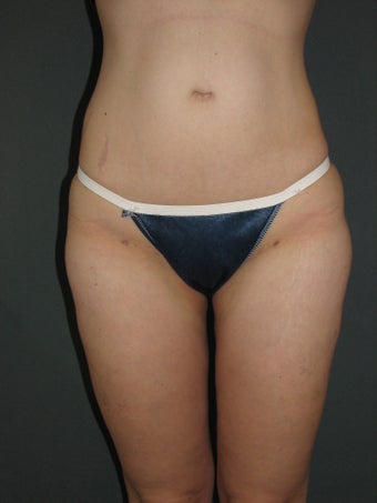 Smart Lipo of Hips, Saddle Bags, and Inner Thighs