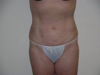 Smartlipo