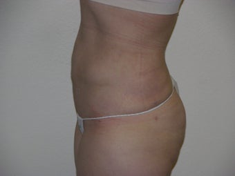 Smart Lipo