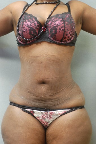 Upper and lower Abdomen & Flanks