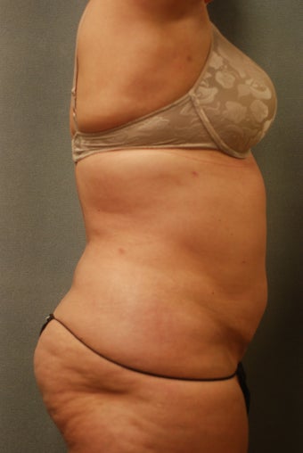 SmartLipo Complete Wrap around 