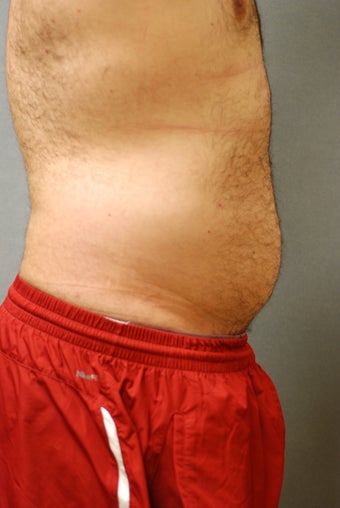 SmartLipo Abs 