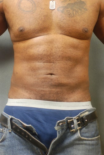 SmartLipo Breasts & Abs 