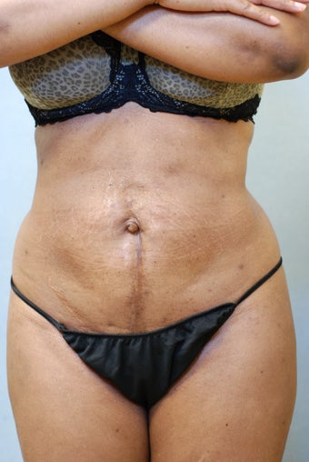 SmartLipo