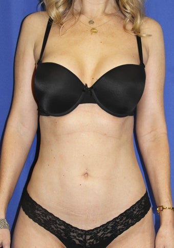 Laser-assisted Liposuction