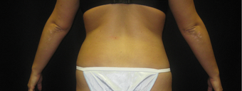 SmartLipo/MPX Flanks
