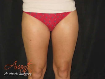 Smart Lipo - Outer Thighs