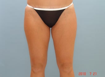 Inner Thigh Smart Liposuction