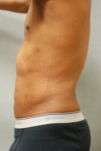 SmartLipo™  Restoration of a Male's Abs 