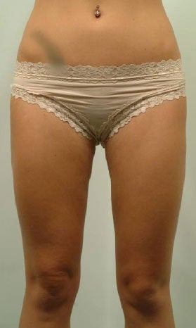Laser Liposuction of Thighs