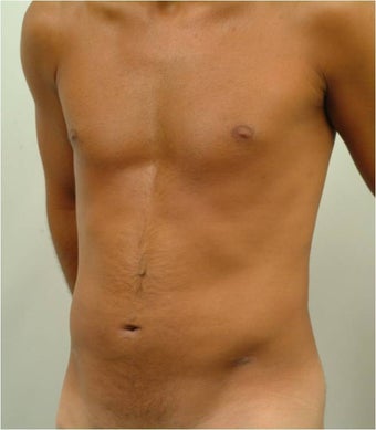Laser Liposuction 