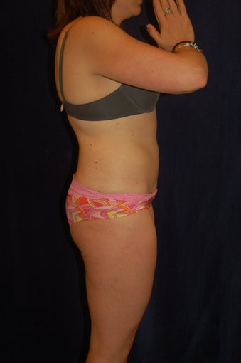 smart lipo - lower abdomen