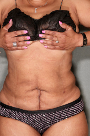SmartLipo™ 