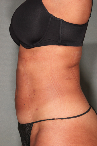 SmartLipo™ 