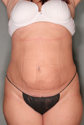SmartLipo™ 