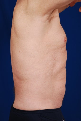 SmartLipo for Abdomen