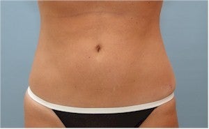 SmartLiposuction