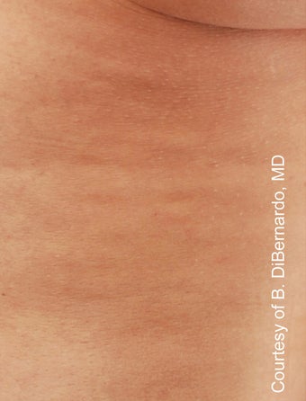 Smart Lipo