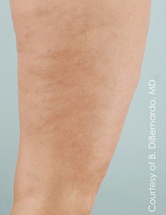 Smart Lipo
