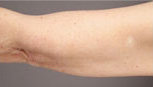 Smart Lipo