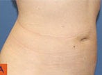 Smart Lipo