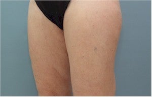 Smartlipo