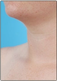 Smart Lipo, Neck Liposuction