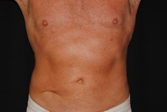 Smart Lipo Abs and Flanks