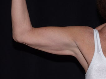 Smart Lipo Arms