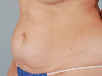 Smart Lipo