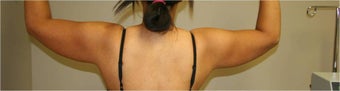 SmartLipo Arms Bilateral