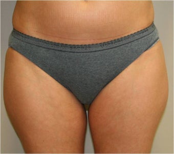 Smart Lipo Saddlebags (moderate)