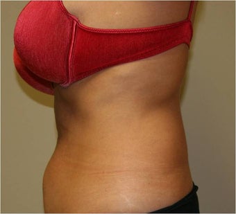 SmartLipo Love Handles, Lateral View