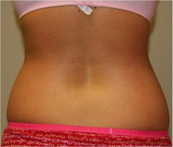 SmartLipo Love Handles Posterior View