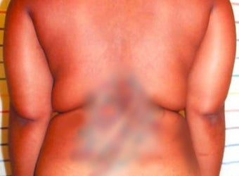 Smart Lipo