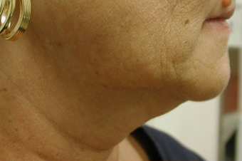 SmartLipo