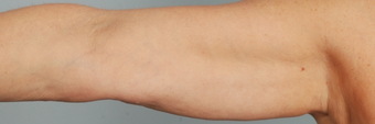 Smart Lipo