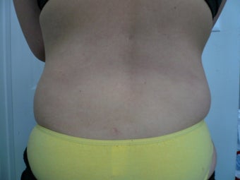 Smartlipo / liposuction