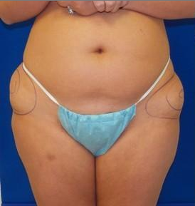 Laser Liposuction