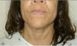 Laser Liposuction
