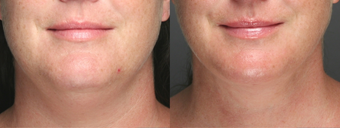 SmartLipo Liposuction of Neck