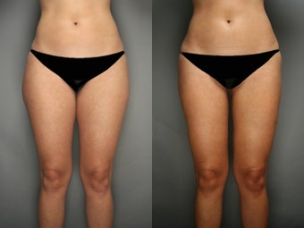 SmartLipo Liposuction of Thighs