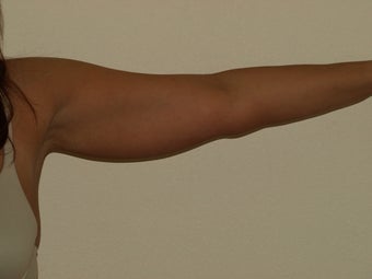 SMARTLIPO