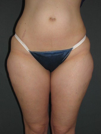Smart Lipo of Hips, Saddle Bags, and Inner Thighs