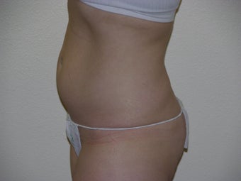 Smart Lipo
